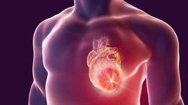Kardiovaskuläre Probleme unter JAK-Inhibitoren – ein Klasseneffekt?