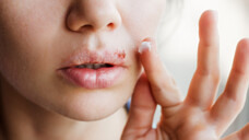 Wie würden Sie es finden, wenn es beispielsweise OTC-Arzneimittel gegen Lippenherpes nur noch auf Rezept gibt? (Foto: domaskina / AdobeStock)
