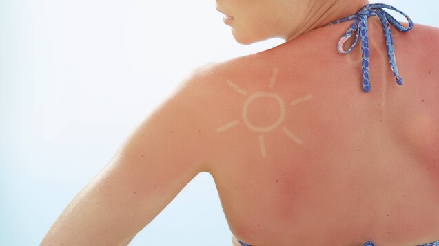 Bei einem Sonnenbrand sind die körpereigenen Schutzmechanismen gefragt, um die Zellschäden zu heilen. (x / Foto: imago images / Science Photo Library)&nbsp;