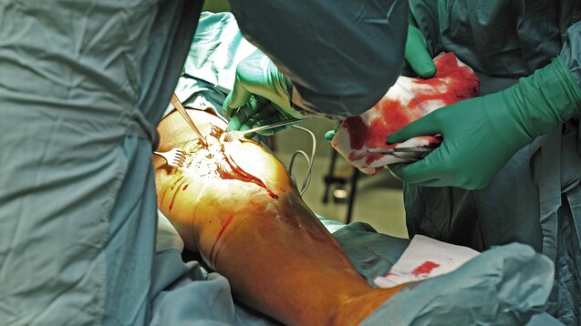 In Deutschland werden zunehmend mehr Kniegelenkersatzoperationen durchgeführt. Vor allem bei den unter 60-järhigen ist eine Zunahem zu verzeichnen. (Foto: Imago)