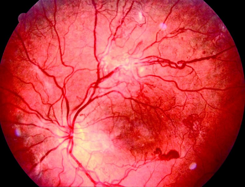 Ангиопатия сосудов головного. Пролиферирующая ретинопатия. Диабетическая ретинопатия сетчатки. Ишемическая ретинопатия. Диабетическая ретинопатия глазное дно.