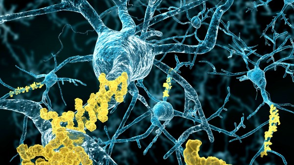 Neues Molekül beseitigt Alzheimer-Plaques