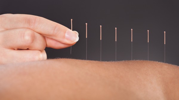 Evidenz für Akupunktur