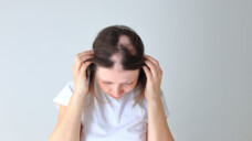 Der kreisrunde Haarausfall ist für viele Erkrankten sehr belastend. Dennoch müssen Patienten für eine Therapie mit Ritlecitinib selbst aufkommen, denn durch §&nbsp;34 SGB V wird die Erstattung von Arzneimitteln „zur Verbesserung des Haarwuchses“ ausgeschlossen. (Foto: Nadya Kolobova/AdobeStock)