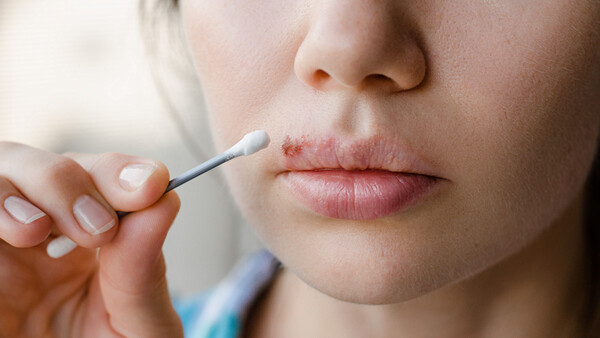 Bläschenalarm – schmieren gegen Lippenherpes 