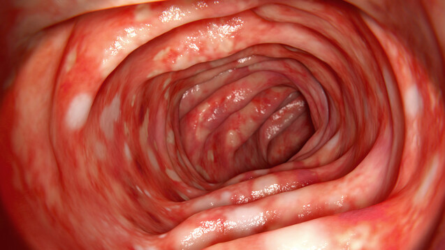 Morbus Crohn und Colitis ulcerosa stellen die beiden Haupt­entitäten der chronisch-entzündlichen Darmerkrankungen (CED) dar. (s/ Foto: crevis / AdobeStock)