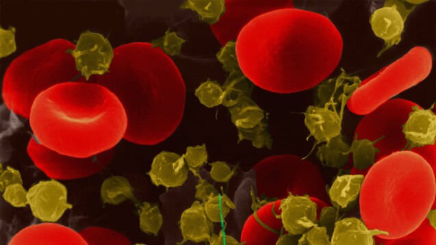 Maligne Erkrankungen fördern die Blidung von Thromben. Welche Rolle können NOAK bei der Prävention tumorassoziierter Thrombosen spielen? (c / Foto: imago)