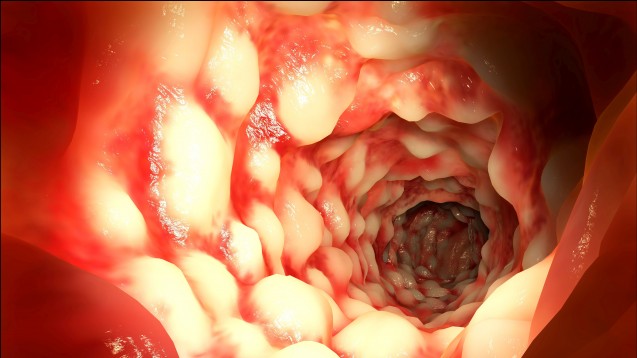 Entzündungen im Darm bei Morbus Crohn. (Foto:  Juan Gärtner / Fotolia)