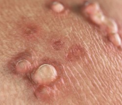 hpv impfung lymphknoten