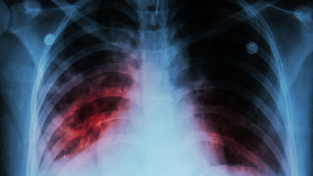 Bis zum Jahr 2035 soll nach dem Willen der Weltgesundheitsorganisation die Zahl der Tuberkulose-Erkrankungen gegenüber 2015 um 90 Prozent sinken. (Foto: stockdevil / stock.adobe.com)