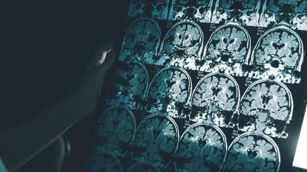 MSD bricht Studie mit Alzheimer-Mittel ab