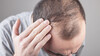 Laut einer Analyse englischer Patientendaten steht Haarausfall auf Platz 2 der COVID-19-Langzeitfolgen. (Foto: andranik123 / AdobeStock)
