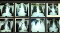Röntgenbilder von an Tuberkulose erkrankten Patienten in der Bibliothek des Tuberkulose-Archivs (DTA) in Heidelberg. (Foto: Imago images / epd).&nbsp;