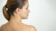 Akne ist die die häufigste
dermatologische Erkrankung im Jugendalter. (Foto: kasanka19 / stock.adobe.com)