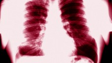 Forscher der TU München und der Texas A&M University haben einen Wirkstoffmechanimus entdeckt, mit dem der Schutzschild der Tuberkulose geknackt werden könnte. (Foto: Picture Alliance)