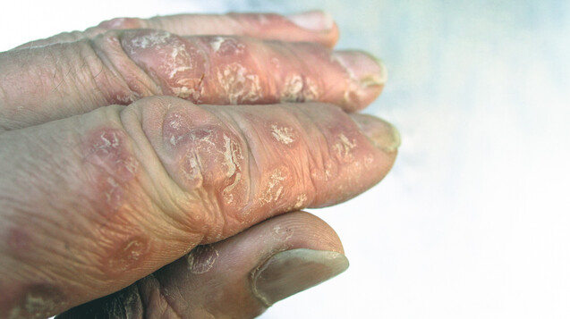 Nur eine Hauterkrankung? Eine Händedesinfektion mit Psoriasis an der Hand fühlt sich an wie Feuer. (s / Foto: imago images / Rolf Braun)