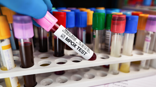 Mutierte Mpox-Viren lassen Fallzahlen steigen