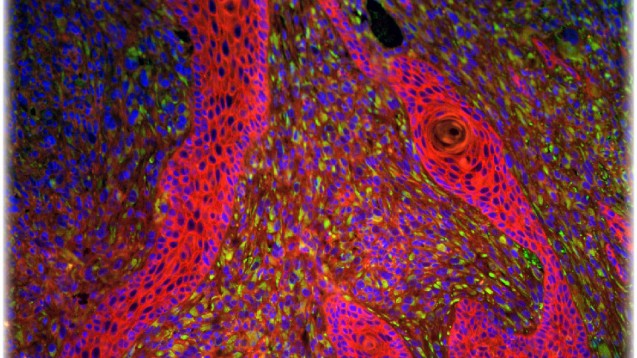 Ein Plattenepithelkarzinom unter dem Mikroskop, dessen Entstehung durch Papillomaviren begünstigt wird. Die Zellkerne sind blau dargestellt.(Quelle: Hasche et. al., PLOS Pathogen DOI: 10.1371/journal.ppat.1006723)