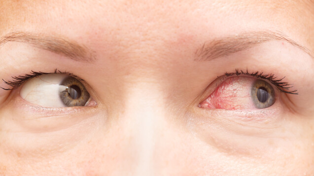 Nicht immer harmlos: Auch schwerwiegende Augenerkrankungen können mit einer Bindehautentzündung einhergehen. (m / Foto: rafur / stock.adobe.com)