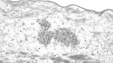 Papillomviren in der äußeren Hornhaut (Stratum corneum) eines Hauttumors einer Mastomys coucha (Vielzitzenmaus). (Foto: Michelle Neßling / DKFZ)