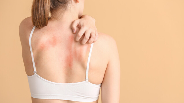 Bei Hautläsionen sollten Menschen mit einer chronisch entzündlichen Darmerkrankung hellhörig werden. (Foto: AdobeStock / Pixel-Shot)