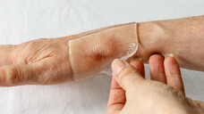 Behandlung einer postoperativen Narbe mit einer luftdichten Abdeckung aus Silikongel. (x / Foto: BarTa / AdobeStock)