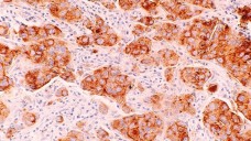 Krebszelle: Wie wirken Antikörper-Wirkstoff-Konjugate mit Immuntherapie kombiniert? (Foto: National Cancer Institute)
