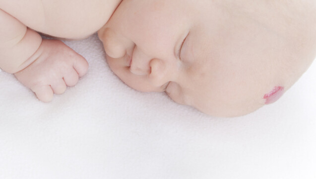 Muss der Blutschwamm am Kopf eines Babys behandelt werden? ( r / Foto: Franziska Krause / stock.adobe.com)