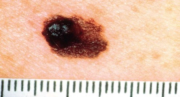 Hautkrebs seltener unter Therapie mit NSAID? Fall-Kontroll-Studie mit überraschenden Ergebnissen