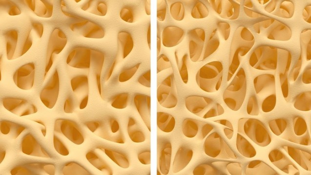 Illustration (Ausschnitt): Gesunde Knochenstruktur - und solche mit Osteoporose. (Foto: eranicle / Fotolia)