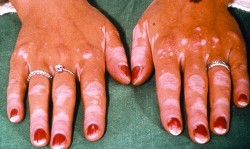 D122010_pri_vitiligo.jpg