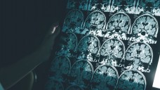 Alzheimer – noch immer hat die Forschung keinen Weg gefunden, die Erkrankung zu stoppen oder jedenfalls zu verlangsamen. (Foto:  Atthapon / stock.adobe.com)