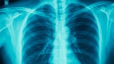 Kooperation in der COPD-Therapie: Die Propeller-Technologie registriert nach Angaben des Unternehmens, wie und wann Patienten die inhalierten Lungenmedikamente anwenden. (Foto: BillionPhotos.com / Fotolia)