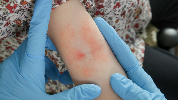 Upadacitinib punktet bei atopischer Dermatitis