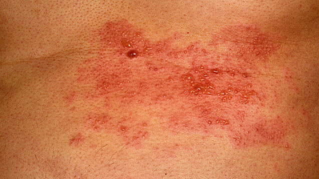 Der Herpes zoster stellt keine Neuinfektion, sondern ein Rezidiv einer Windpockeninfektion dar. (s / Foto: hawanafsu / stock.adobe.com)