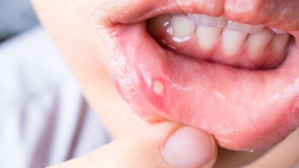 Was hilft bei Bläschen im Mund?