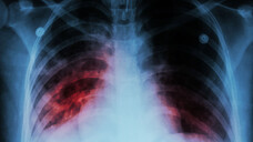 Bis zum Jahr 2035 soll nach dem Willen der Weltgesundheitsorganisation die Zahl der Tuberkulose-Erkrankungen gegenüber 2015 um 90 Prozent sinken. (Foto: stockdevil / stock.adobe.com)