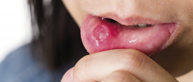 Am nicht herpes mund heilt Lippenherpes: Ursachen,