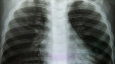Schätzungen zufolge sind in Deutschland drei bis fünf Millionen, in den USA etwa 16 Millionen und weltweit etwa 600 Millionen Menschen an einer COPD erkrankt. (Foto: toeytoey / Fotolia)