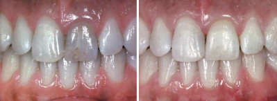 Grau zahn wird Zahnverfärbung: Sechs