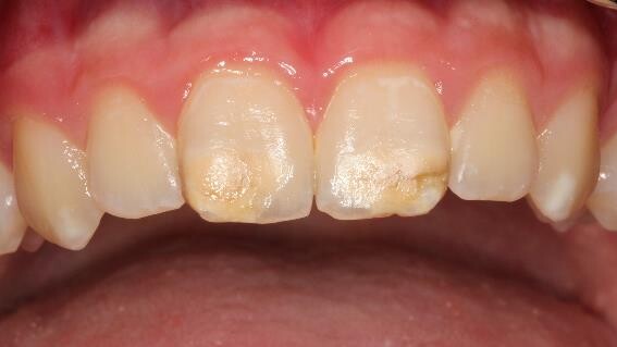 Schwere Formen der „Kreidezähne“ weisen abgesplitterte oder fehlende Schmelzareale unterschiedlichen Ausmaßes auf. Die Frontzähne sind häufig ebenfalls betroffen. ( r / Foto: DGZMK)