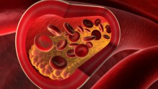 Alirocumab ist eine neue Therapieoption bei Hypercholesterolämie (psdesign1/Fotolia)