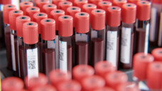 Noch kann man Long COVID nicht mittels einer einfachen Blutanalyse diagnostizieren. Es fehlt an eindeutigen Biomarkern. (Foto: Steffen Kögler / AdobeStock)