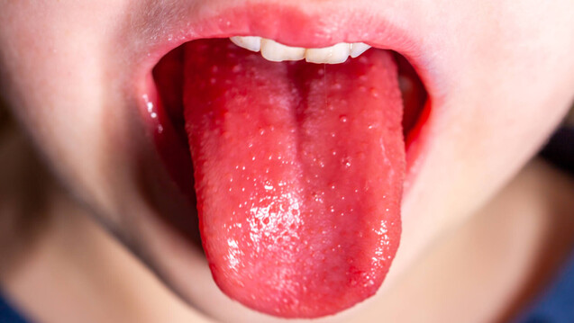 Zu den Symptomen von Scharlach können auch die periorale Blässe und die Himbeerzunge (vergrößerte Papillen auf einer belegten Zunge, die sich später schält) zählen. (x / Foto: Lukassek / AdobeStock)