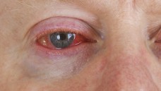 Vielleicht eine Augengrippe? Ein rotes Auge kann vielfältige Ursachen haben. (Foto: Birgit Reitz-Hofmann / Fotolia)