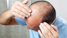 Wer seinen Haarausfall mit Minoxidil bekämpft, riskiert allergische Reaktionen. (Foto: Kurhan / Fotolia)