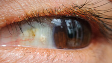 Bei chronischen Formen der Blepharitis (Lidrandentzündung)&nbsp;kommt es zu Verkrustungen oder/und Schuppenbildung an der Wimpernbasis.&nbsp;(s / Foto: ohishiftl / AdobeStock)