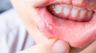 Was hilft bei Bläschen im Mund?