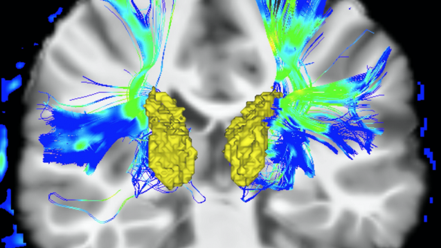 Koronale Ansicht eines menschlichen Gehirns eines Parkinson-Patienten. Gelb markiert ist die Oberfläche ist der Nucleus caudatus, blau / grün die Fasern des motorischen Systems. (Darstellung: dpa)
