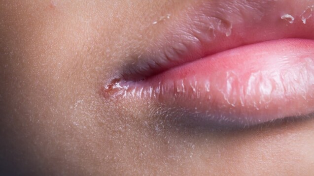 Mundwinkelrhagaden können vielfältige Ursachen haben. (s / Foto: frank29052515
                                        
                                                    / stock.adobe.com)